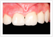 porcelain crowns after mill creek wa dentist