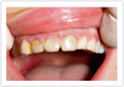 mill creek dentist porcelain crowns