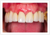 mill creek wa dental bridges after