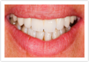 dental veneers after mill creek wa