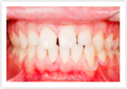 teeth whitening after mill creek wa